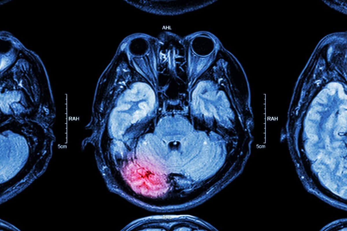 traumatic-brain-injury-recovery-stages