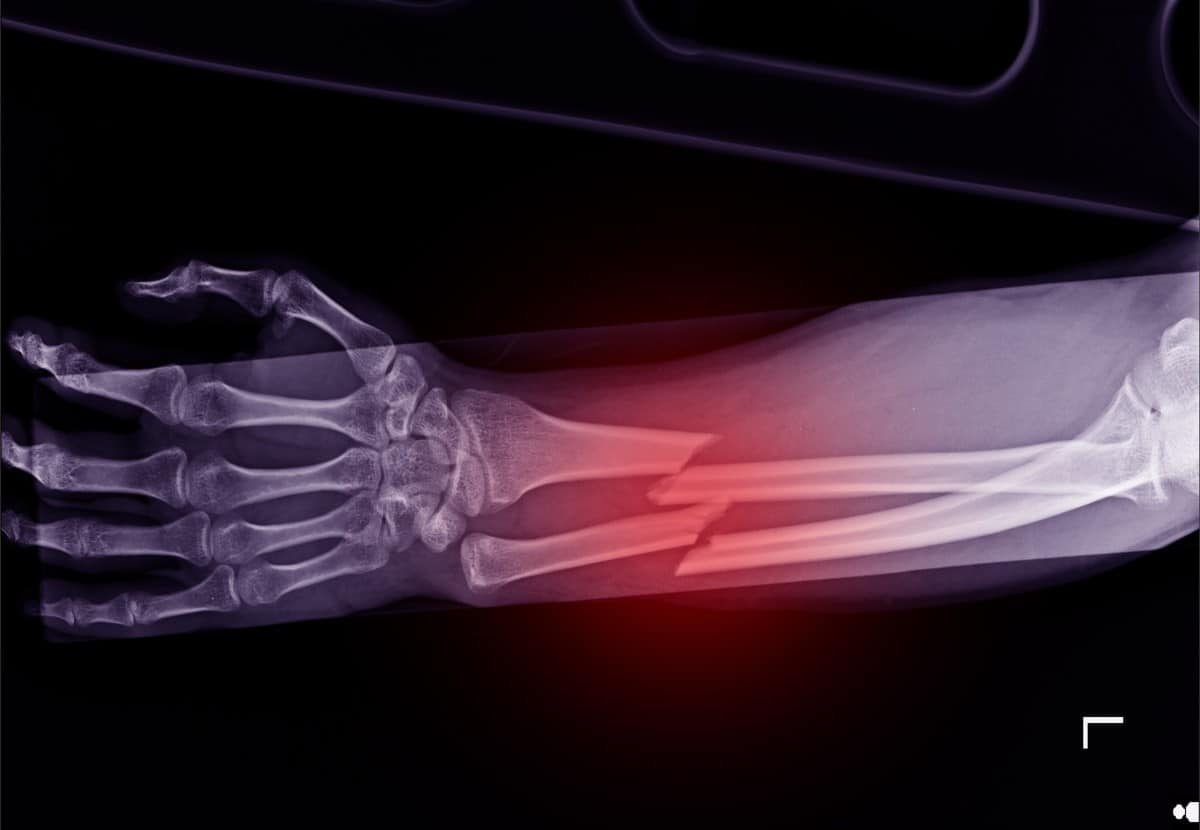 signs-a-broken-bone-is-not-healing-university-of-maryland-medical-center