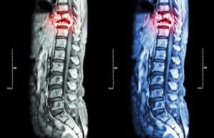 New Technologies to Treat Spinal Cord Injuries